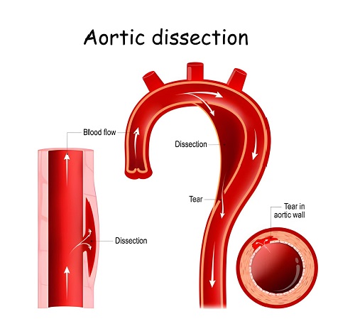 Best Aorta Aneurysm and Dissection Doctor in Andheri, Mumbai